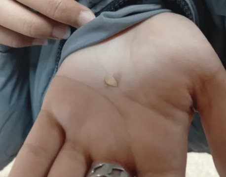 Escándalo en una escuela de Plottier: encontraron un diente en la comida del&nbsp;comedor